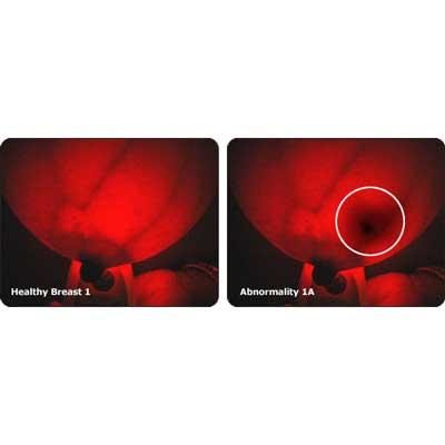 Breastlight™-Earlier Breast Screening Device - Image 3