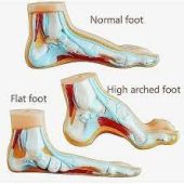 normal flat and arched foot anatomy